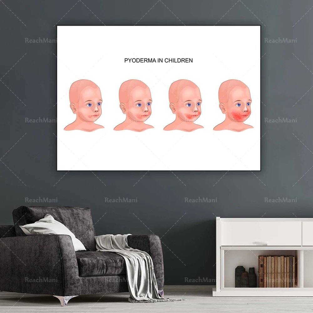 Pyoderma on baby face vector image decorative canvas print poster
