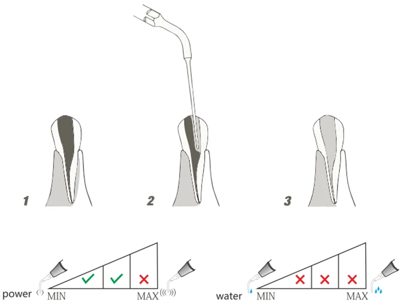 5 adet ultrasonik ölçekleyici İpucu E4 EMS ve ağaçkakan için endodontik ipuçları diş macunu doldurma ipuçları kaldırma araçları