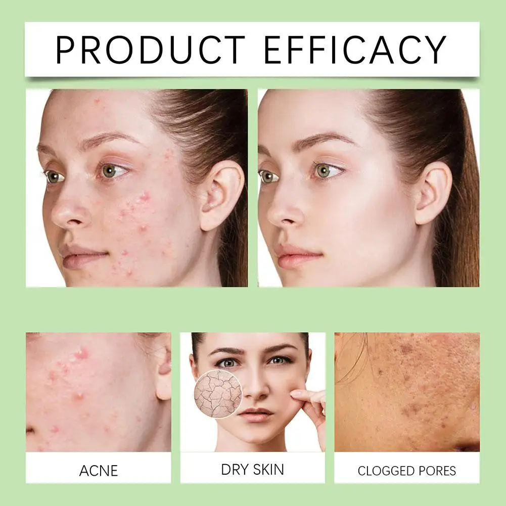 30 мл эффективная жидкость для удаления прыщей, удобная жидкость для удаления прыщей, улучшение прыщей, удобный раствор для восстановления лица, средства по уходу за кожей