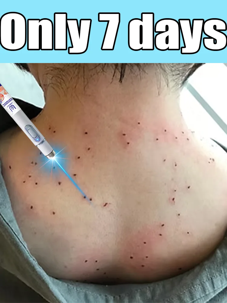 

Bᴇsᴛ-sᴇʟʟɪɴɢ ʙʟᴜᴇ ʟɪɢʜᴛ ᴡᴀʀᴛ ᴘᴇɴ, ʙᴏᴅʏ ᴡᴀʀᴛ ʀᴇᴍᴏᴠᴀʟ ᴛᴏᴏʟs