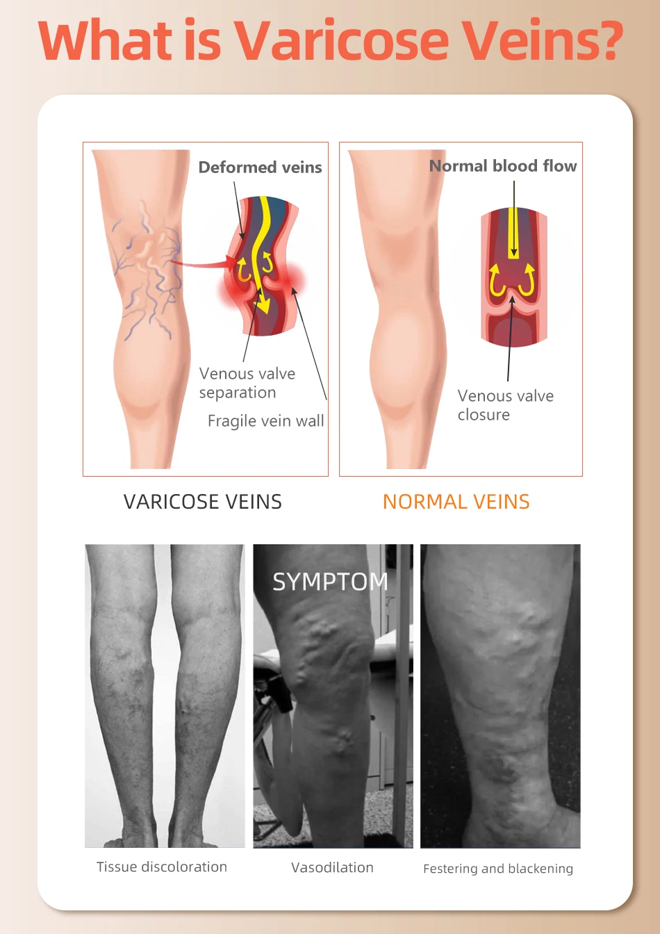 Leg beauty 34-46mmhg medizinische Kompression strümpfe Unisex Knie hoch elastische Klasse 3 Drucks trümpfe Schlaf füße Krampfadern behandeln – Detail 8