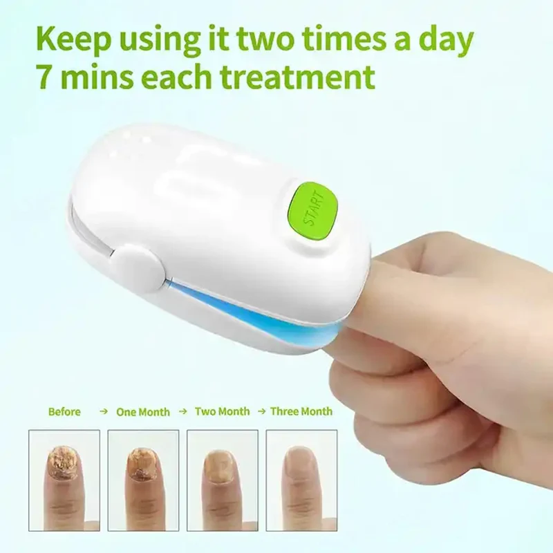 905NM Painless Nail Fungal Treatment Device Laser Hand and Foot Care Whitening Nail Removal Fungal Infection Nail Treatment Devi