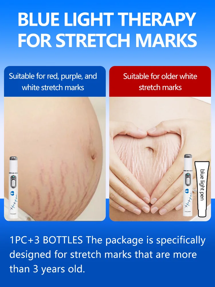 Envío gratis, ayuda a personas con estrías, resuelve sus problemas y sin problemas, herramienta de bolígrafo con luz azul
