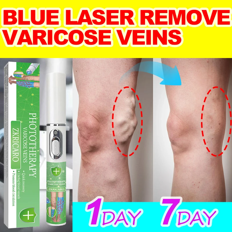 

High tech Laser therapy improves moderate varicose veins, Relieves pain and improves circulation in men and women