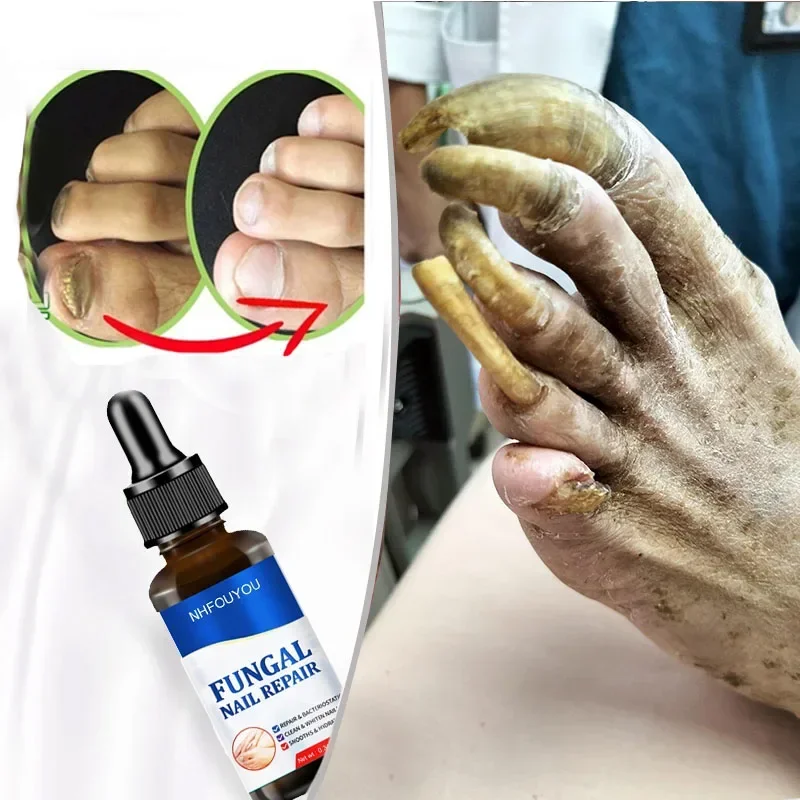 Fungal Nail Treatment Oil Foot Repair Essence Toe Nail Fungus Removal Gel Anti Infection Cream Fungal Nail Removal 10ML