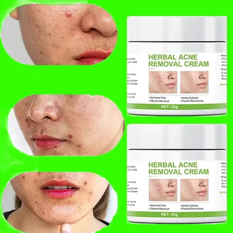 

Effective Acne Removal Cream Treatment Acne Scar Shrink Pores Oil Control Whitening Moisturize Face Ginseng Herb Acne Skin Care