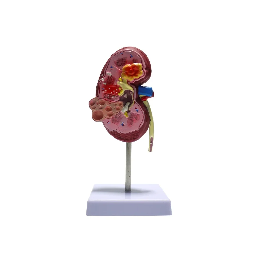 Medical teaching aids for human normal and pathological kidney models
