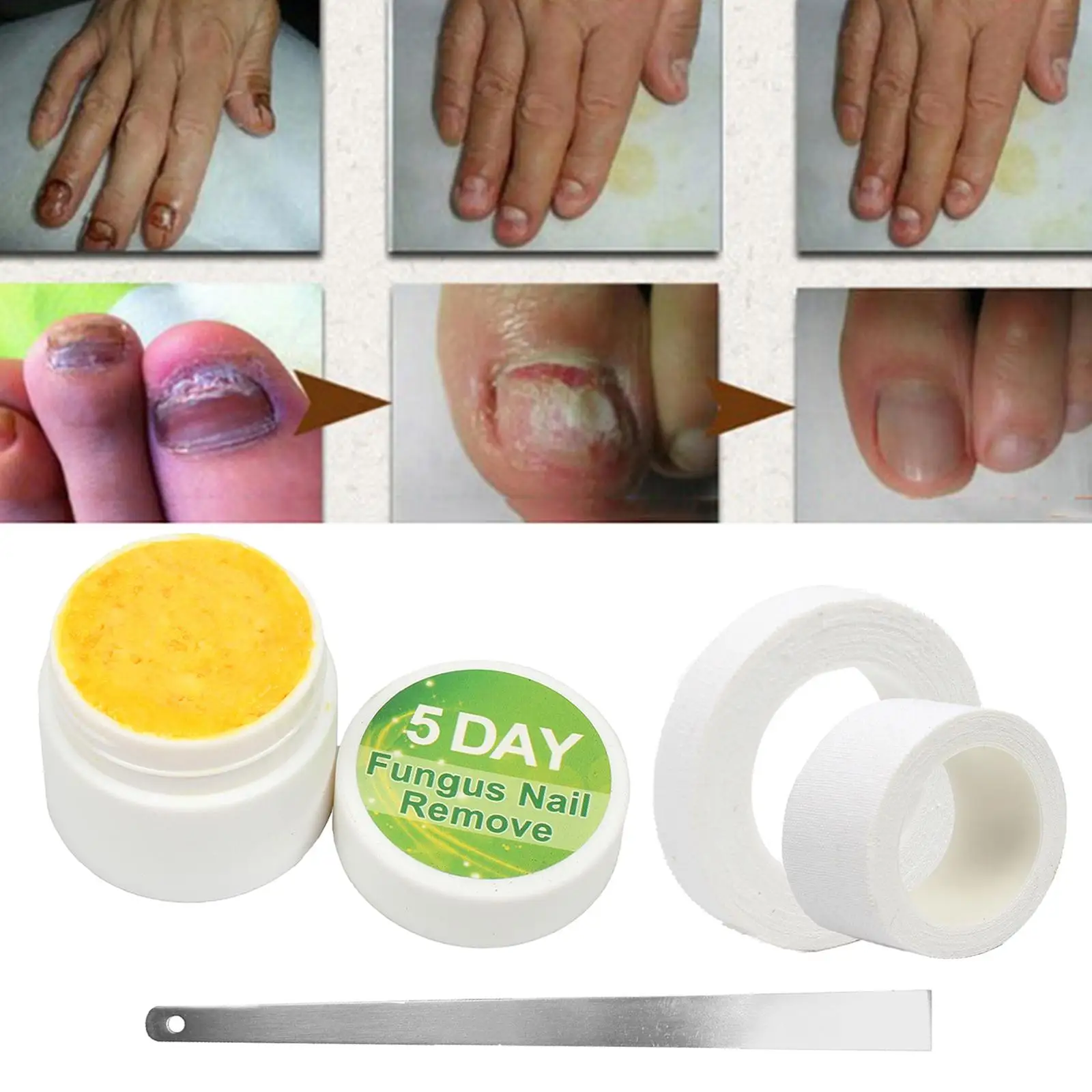 Sérum de réparation fongique des ongles, Essence, traitement des ongles des pieds, Gel d'élimination des champignons, Anti-onychomycose, soin des ongles des pieds