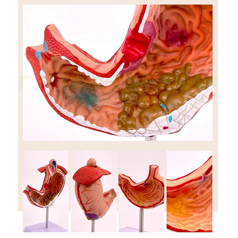 Human gastric model pathological gastric model with diaphragm gastric disease demonstration pathological gastric ulcer/ulcer ana