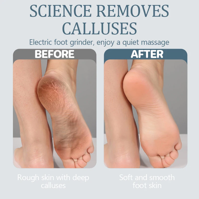 Nieuwe Elektrische Callus Remover Voor Voeten Oplaadbare Elektrische Voet Callus Remover Koppen Voet Grinder Voor Dode/Harde Gebarsten/Droge Huid