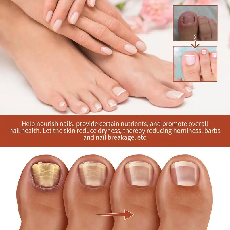 Natural Nail Strengthener Nail Repair Nail Care Essence Providing Rich Nutrition And Aiding In Nail Repair Nail Care Product For