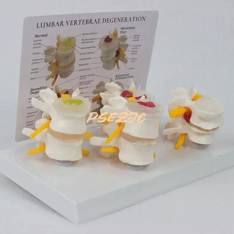 Stage 4 Pathology Lumbar Spine Human Model Orthopedic Teaching Demonstration Assisted Demonstration Teaching (with Back Card)