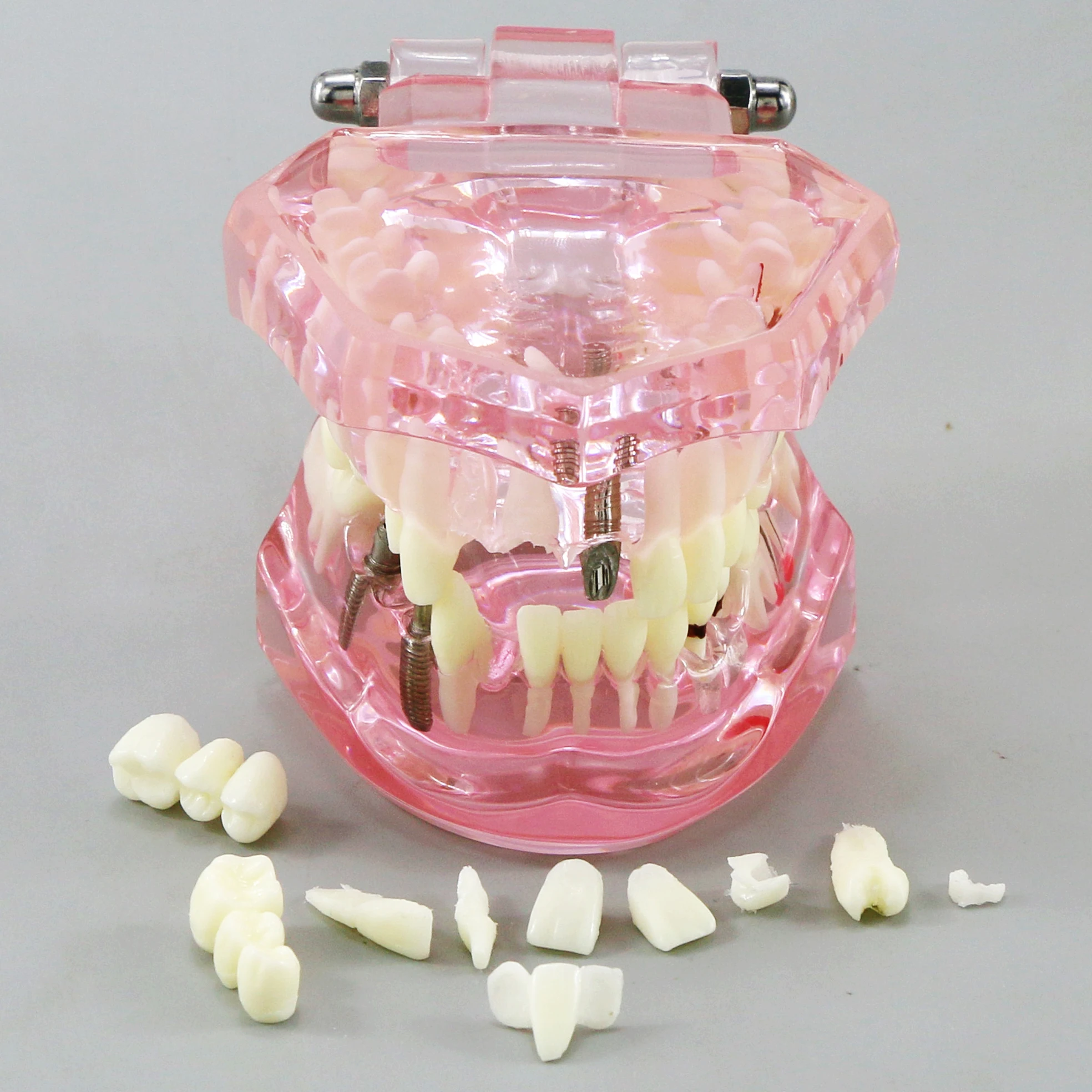 Dental Teeth Model Teaching Model Implant Disease Teeth Repair Restoration Bridge for Dentist Teaching Studying Demo M2001 Pink.