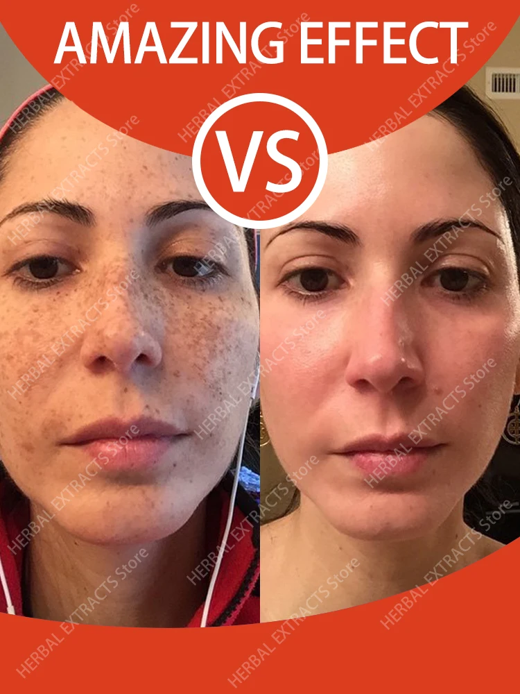 Dark Spot Remover Melasma Chloasma Freckles Spot Removal Cream