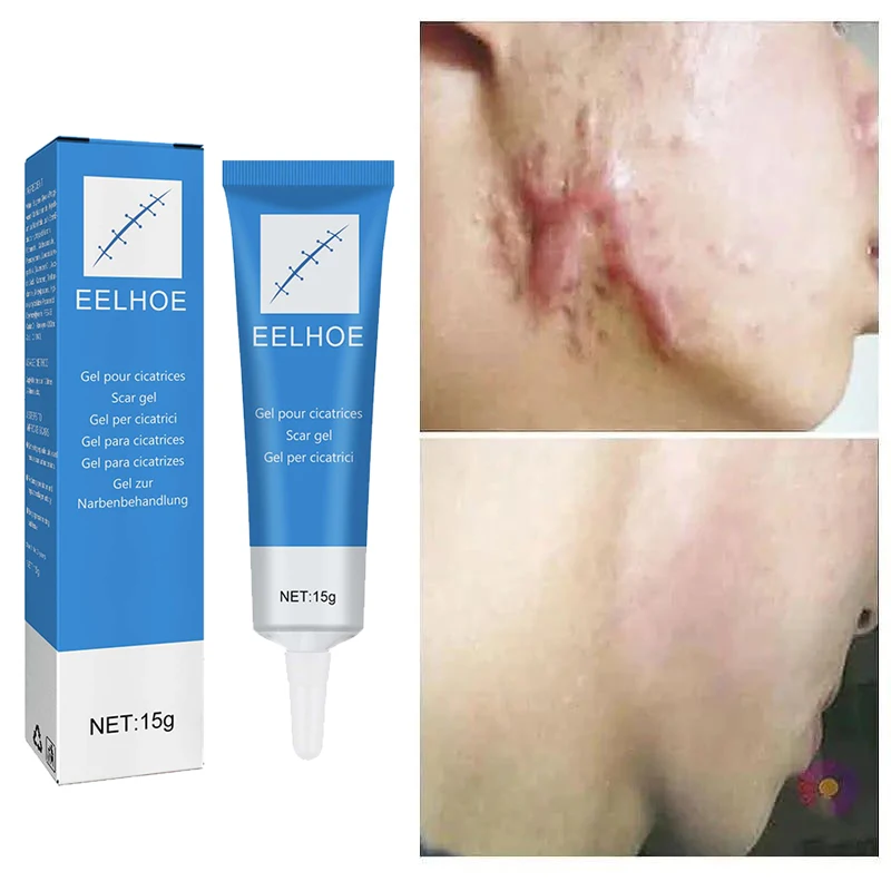 Old Scar Repair Cream Effective Repair Surgical Scars Stretch Marks Acne Pits Acne Marks Burn Scars  Moisturizing Skin Repair