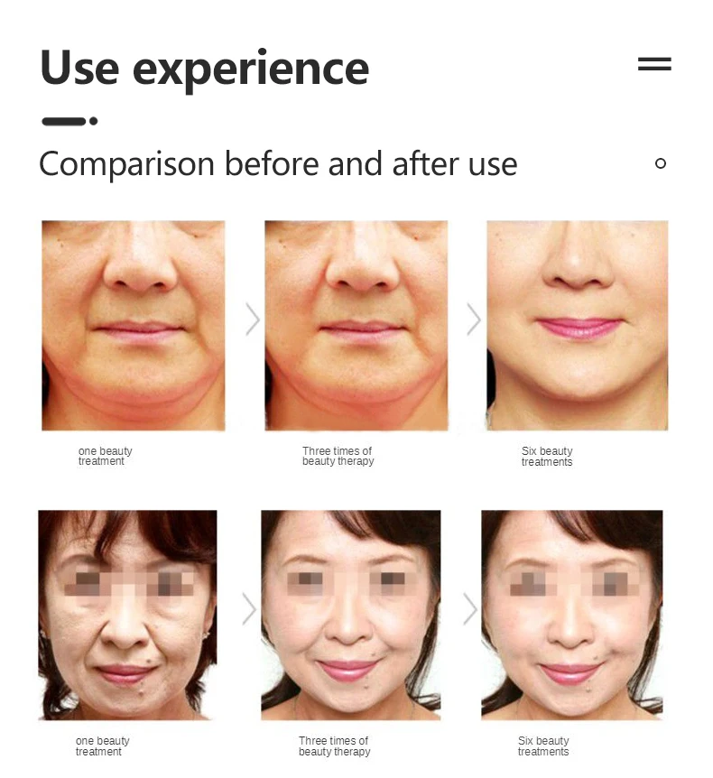 2 In 1 V-Mate Vmax No-cartridges Vmax Facial Lifting V Line Carving Skin Tightening Device Skin Tightening Machine