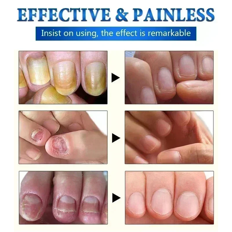 Remoção de fungos nas unhas 10ml, óleo para tratamento de unhas fúngicas, essência para reparo de pés, gel para remoção de fungos nas unhas dos pés, creme anti-infecção