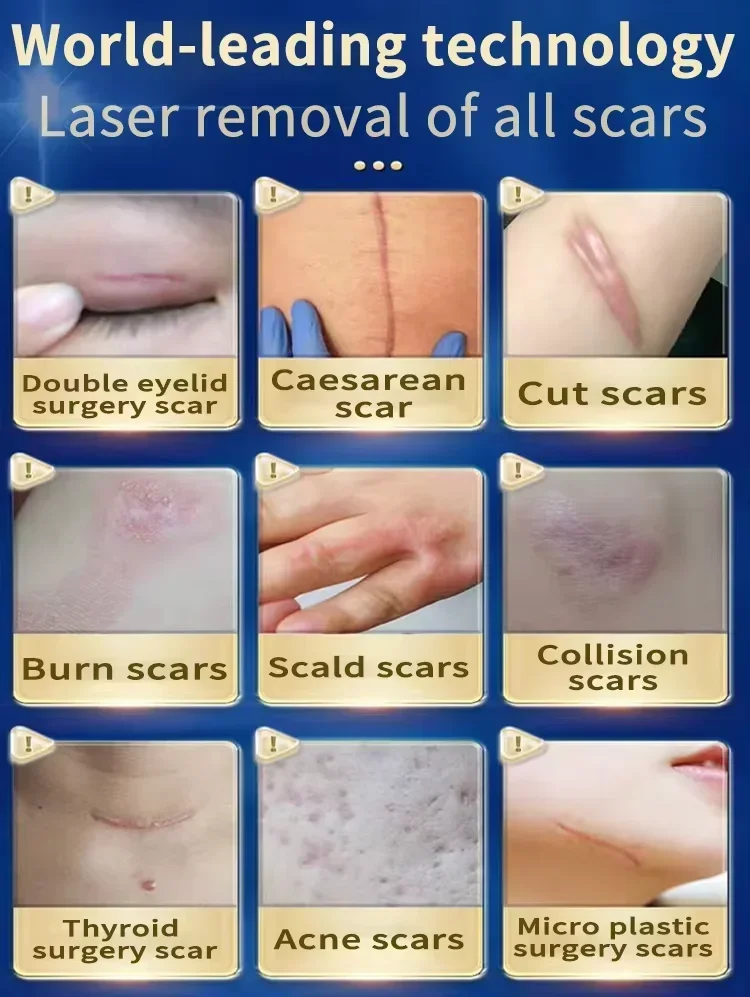 Laser keloid repair