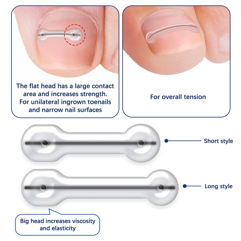 1Pc piede incarnito strumento di correzione dell'unghia del piede trattamento delle unghie dei piedi incarniti adesivo Patch elastico raddrizzamento Clip Brace Pedicure Tool