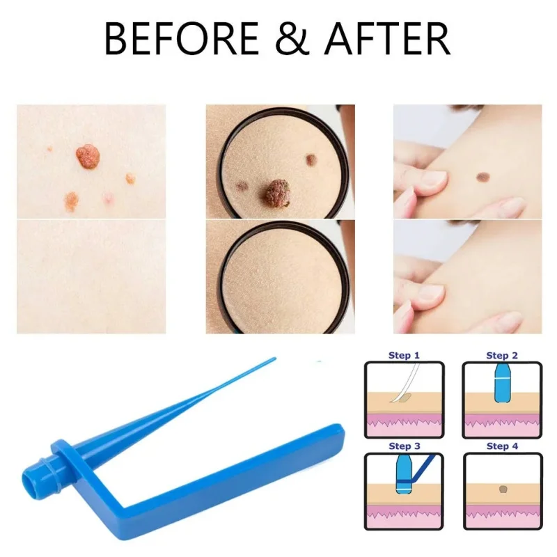 Medical Skin Tag Kill  Mole Wart Remover Skin Tag Remover Kit Treatment with Cleansing Swabs Adult Mole Wart Face Care Tools