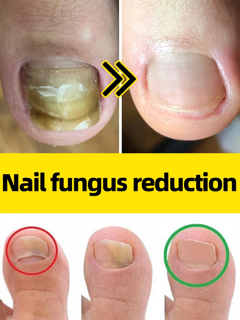 

brighten your nails,Eliminate fungi