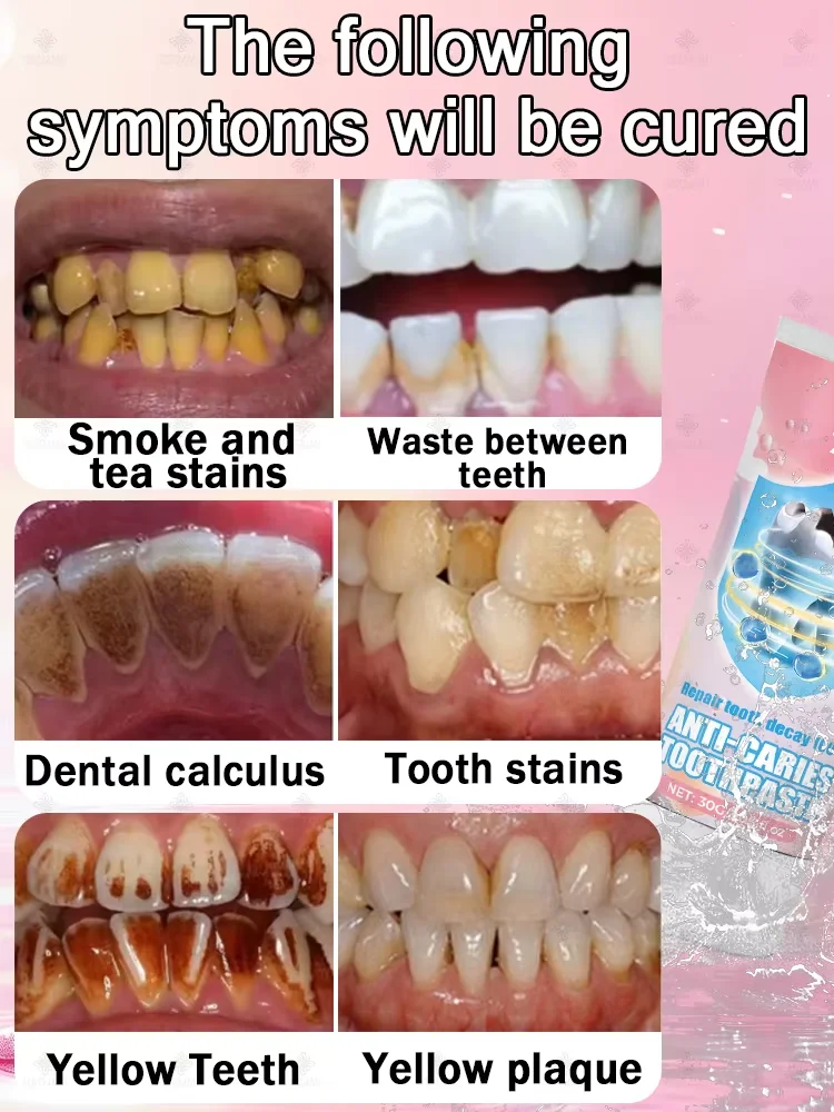 Pasta de dente branqueadora natural dos dentes - fórmula anti-amarelecimento |   Resultados rápidos, alívio de sensibilidade e frescor de longa duração