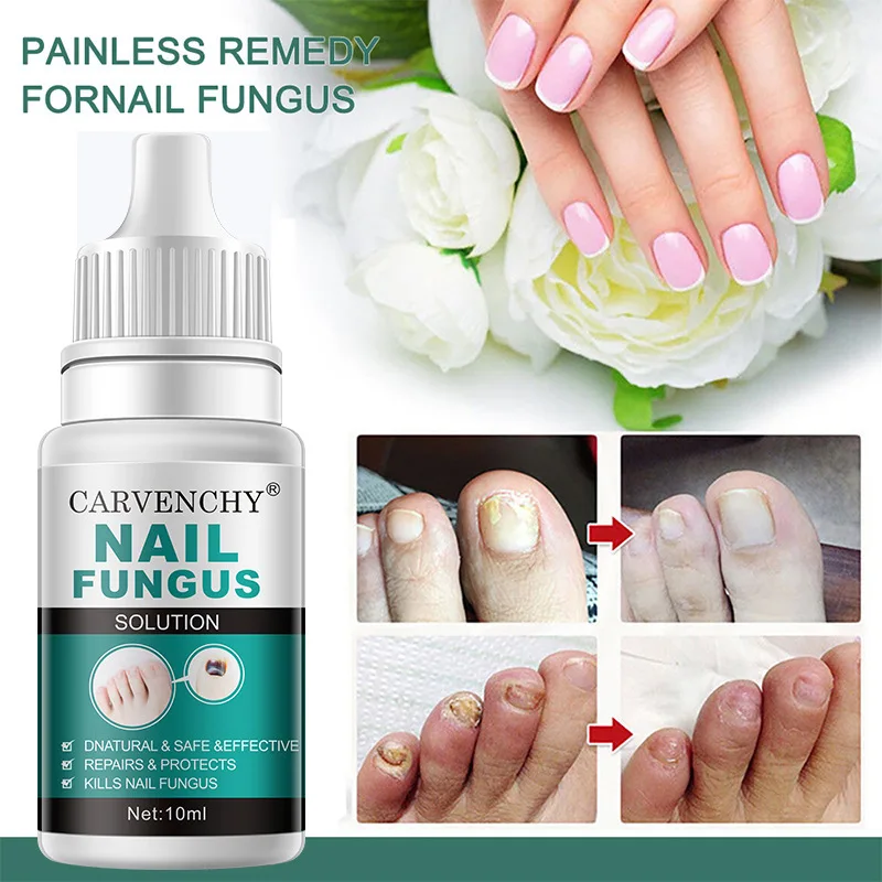 علاج الأظافر المضاد للعدوى ، المصل السائل ، مضاد للعدوى ، فطار الأظافر ، الداحس ، العناية باليد ، الأظافر والقدم ، جل إزالة الفطريات ، 10 * ، 7 أيام