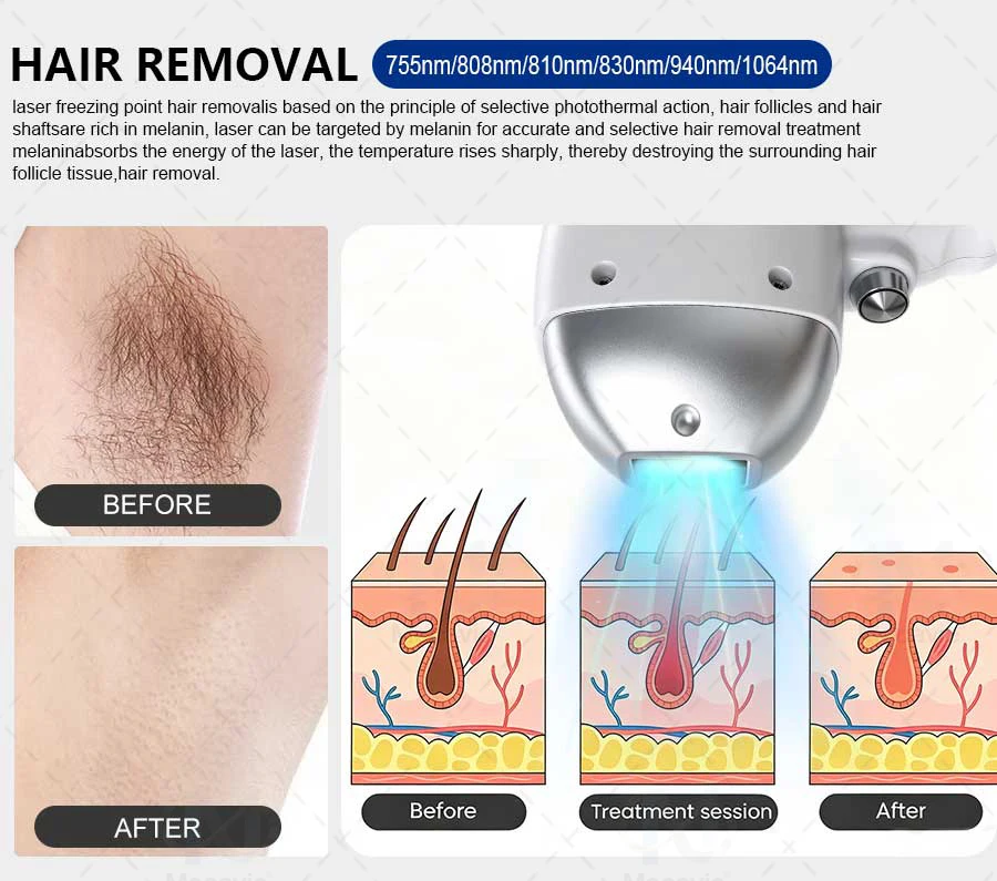 Soprano 2026 New FAC Ice Platinum Cooling System 808nm Diode Laser Hair Removal Device - Best Brand, 4 Wavelengths, 4000W Painle