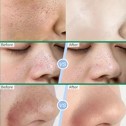 6 best sales रोमछिद्र हटाने वाली क्रीम - №2