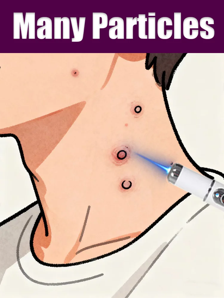 

Blue light pen for warts eliminates various types of warts at their source.