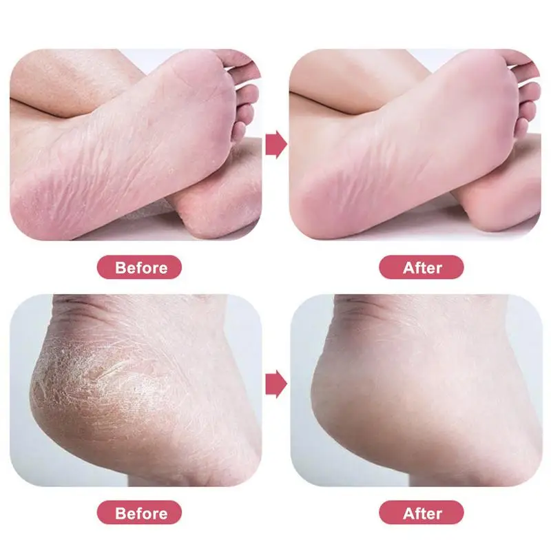 Foot Hard Skin Callus Remover Foot Exfoliation Callus Remover Pedicure Tool Foot File Scrubber Heel Scraper To Remove Dead Skin
