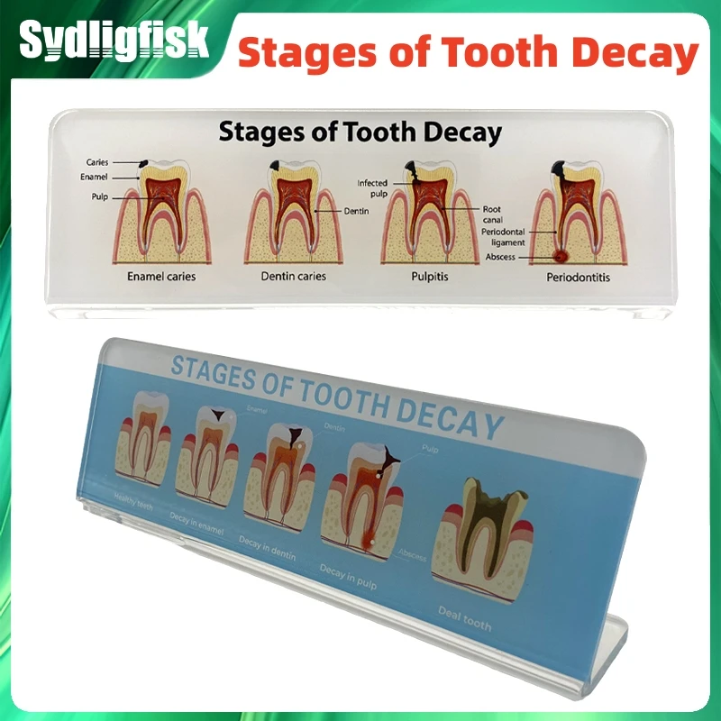 

Dental Model Dental Teaching Model Stages Of Tooth Decay Demonstration Model Doctor-Patient Communication Tooth Model Dentistry