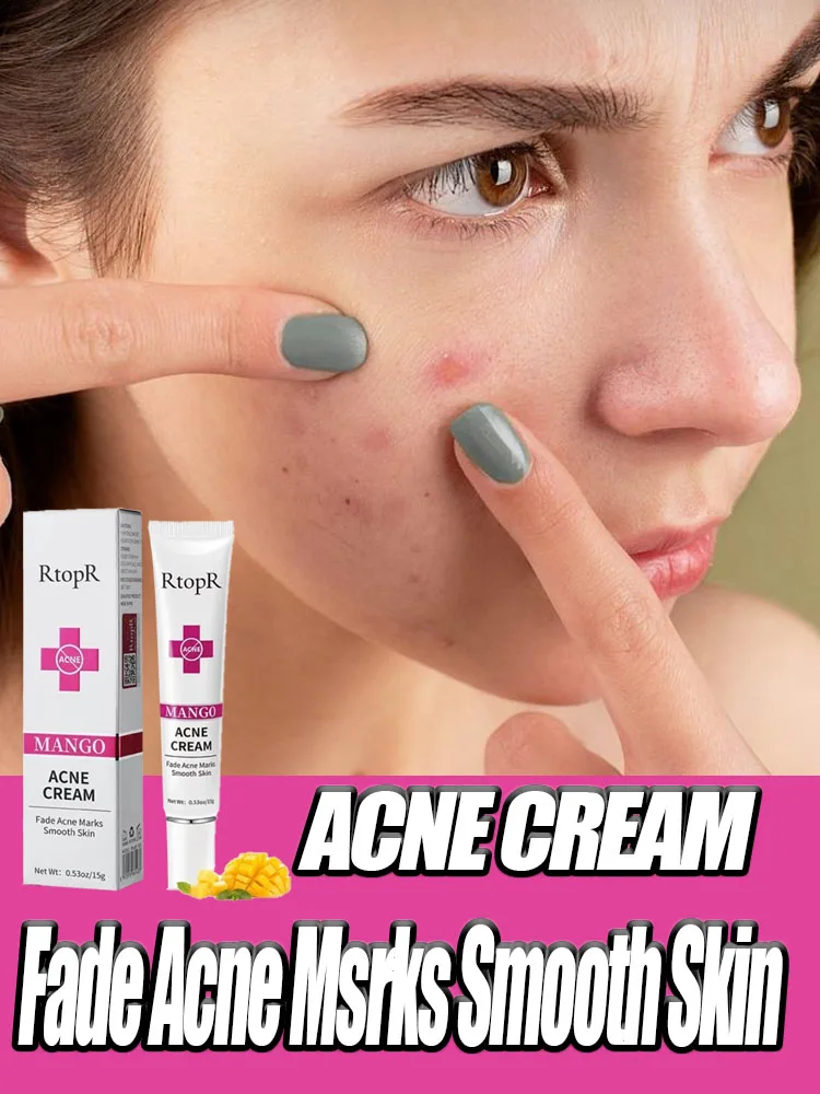 Acne Removal Cream Acne Mark remover Acne Mild Repair Damaged Hydration Nourishment Rejuvenation face Brightening Skin Care