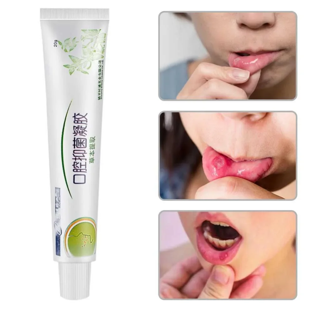 Mouth Ulcer Relief Gel Natural Herbal Oral Hygiene Antibacterial Cream Severe Pain Irritation Bad Breath Inflammation Creatina