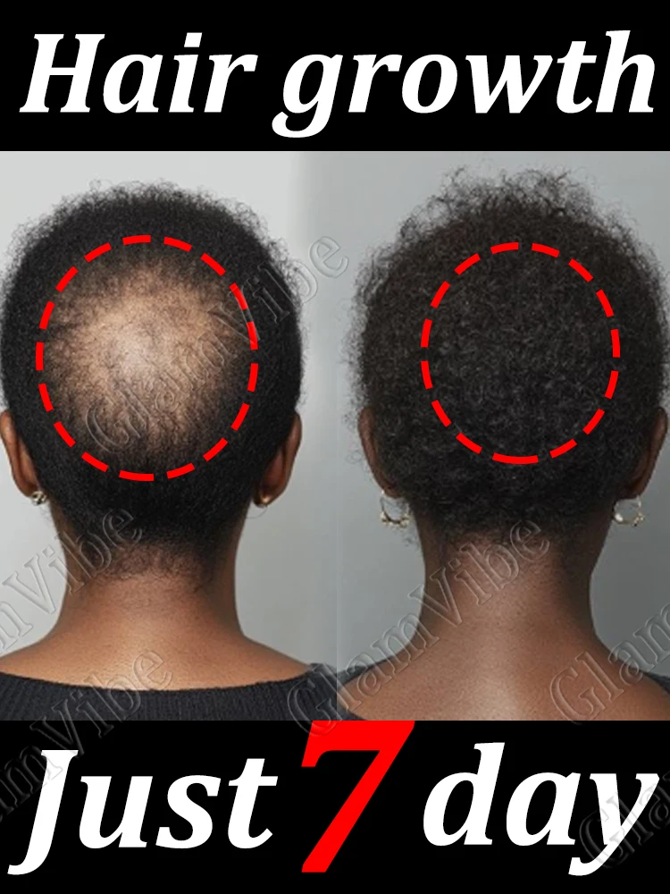 

Hᴀɪʀ ɴᴏᴜʀɪsʜɪɴɢ sᴘʀᴀʏ hair follicles sprout like sᴇᴇᴅs