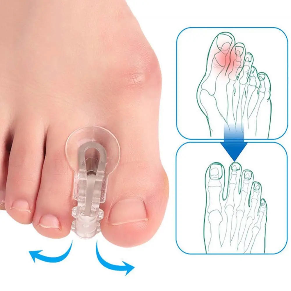 Protetor sobreposição de pés do dedo do pé, ortopédicos de osso, separador de dedo grande, corretor de joanete, ajustador de valgo, alisador ortopédico de pé