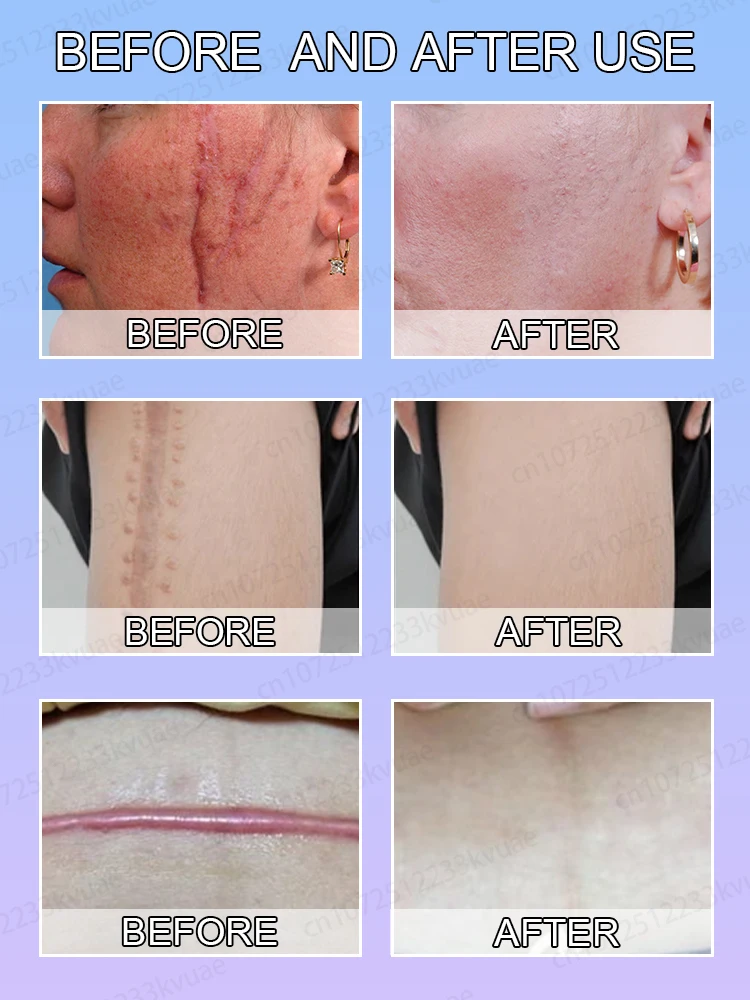 Laserlittekenverwijdering, geschikt voor alle soorten littekens, veilige en gezonde littekenverwijdering