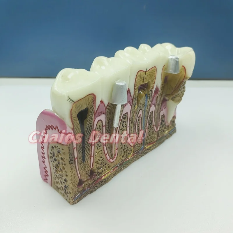 1Pc 6 Times Integrated Pathology Model Dental Implant Model Restoration Pathological Tooth Model Dental Anatomical Model