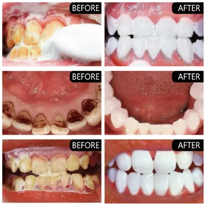 5วันฟอกสีฟันผงขจัดคราบจุลินทรีย์ซ่อมแซมรอยบุบทำความสะอาดลึกยาสีฟันลมหายใจสดชื่นสุขอนามัยช่องปากดูแลฟัน