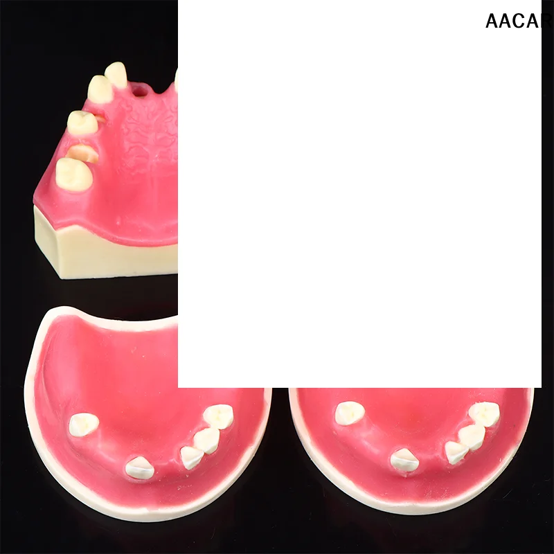 

Teeth Loss Model Dental Implant Student Teaching Training Aid Practice Model Upper Jaw Lift Implants Restoration Model Lab