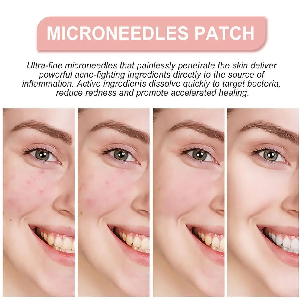 Parches faciales para espinillas, Parche de secado de microagujas, pegatinas para cubrir imperfecciones, cuidado de manchas invisibles, belleza, Dropshippi M8a8, 72 piezas