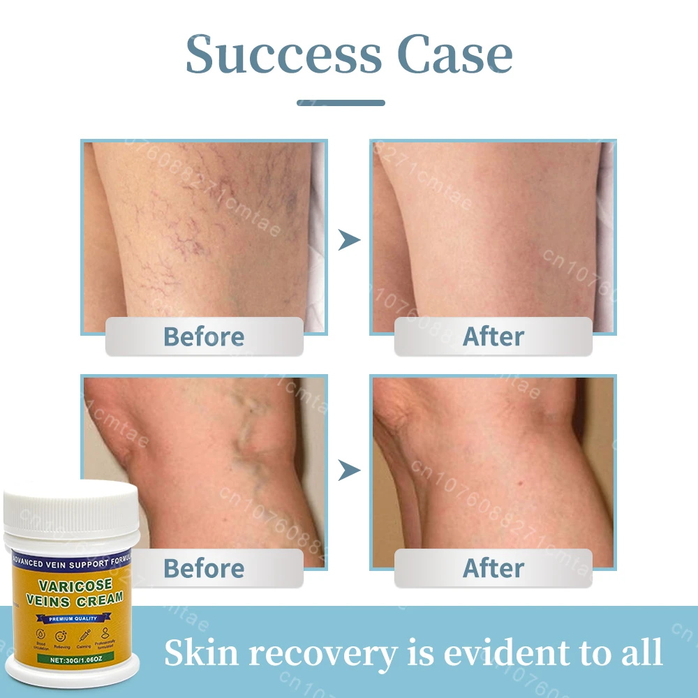 Varicose vein cream relieves itching and pain