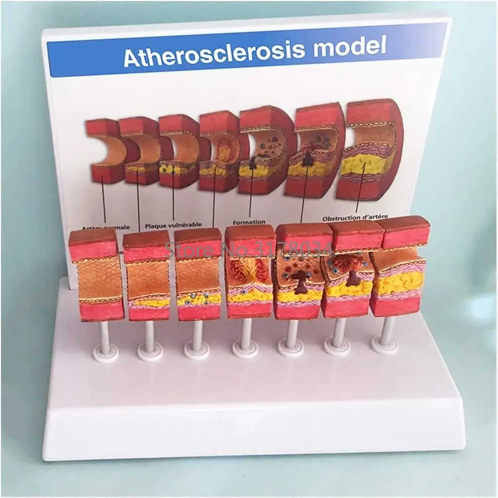 Artery Anatomical Model Anatomical Vessel Atherosclerosis Thrombus Vascular Model Human Artery Anatomy Model