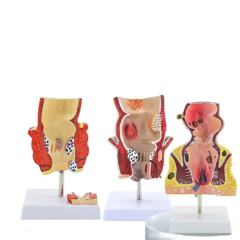 

Модель колоректальных заболеваний дректальных геморроев Внутренняя и внешняя анаректальная модель геморроя