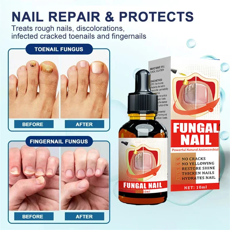 Fungal Nail Treatment Serum Foot Nail Fungus Removal Repair Gel Anti Infection Paronychia Onychomycosis Foot Nails Care Essence