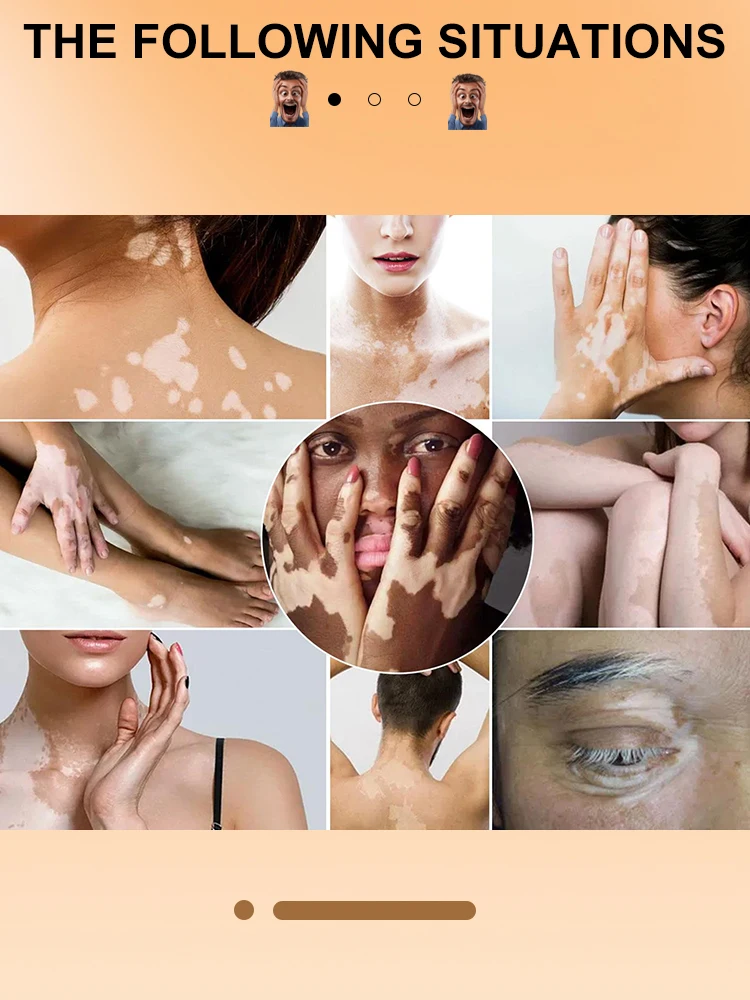 Orginal Whitening Skin Cream Vitiligo Bleaching Creame Face Body Dark Spots Remover Melanin Removal Brightening Decolorizing