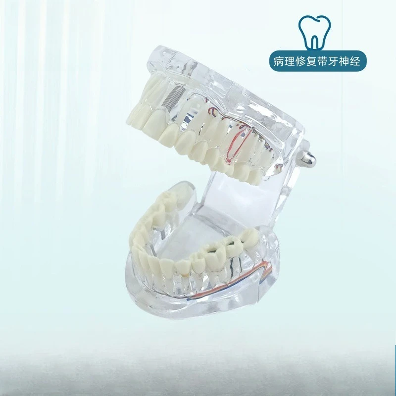 Dental Restoration Model Oral Pathology Doctor-Patient Communication Pathological Restoration Removable Teeth with Dental Nerve