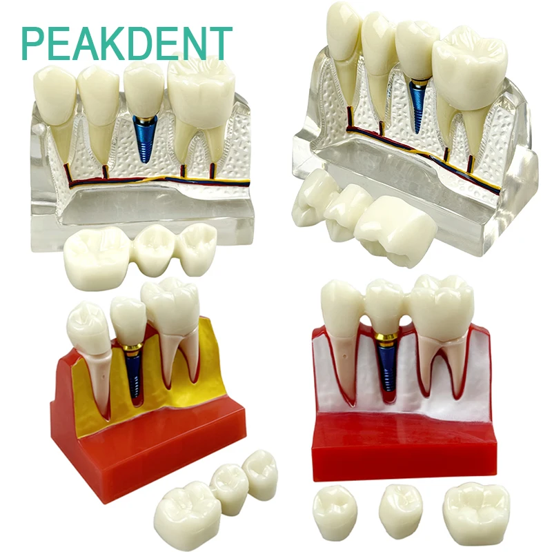 

4 Times Dental Implant Model Dental Analysis Removable Resin Dental Model Teaching Demonstration Research Model