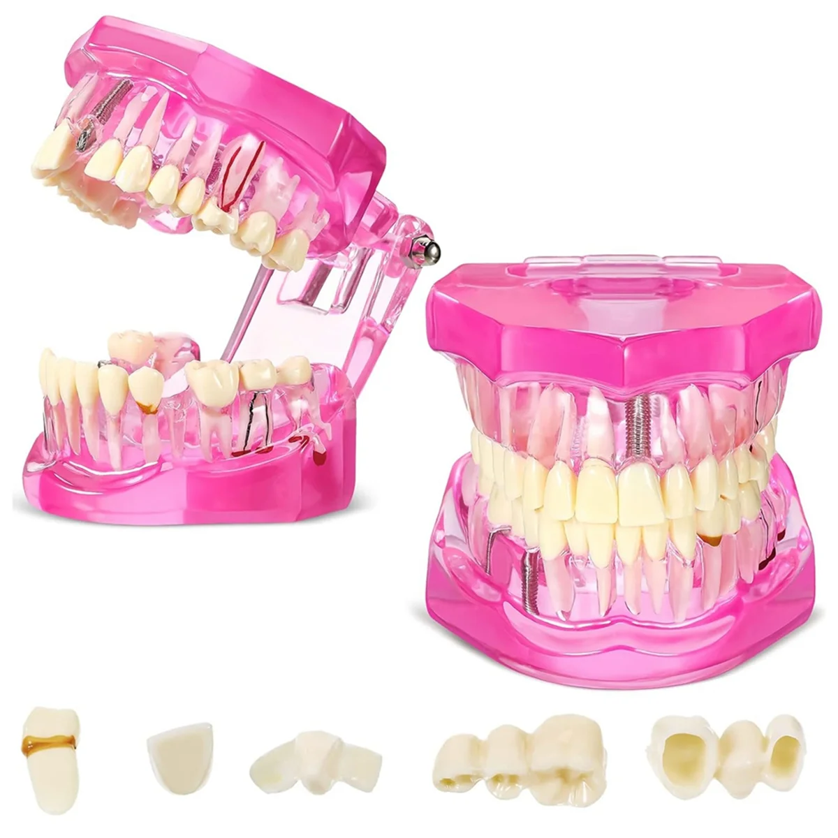 Disease Teeth Model Dental Typodonts Implant Teeth Model with Removable Teeth Pathological Demonstration (Pink,2 Pcs)