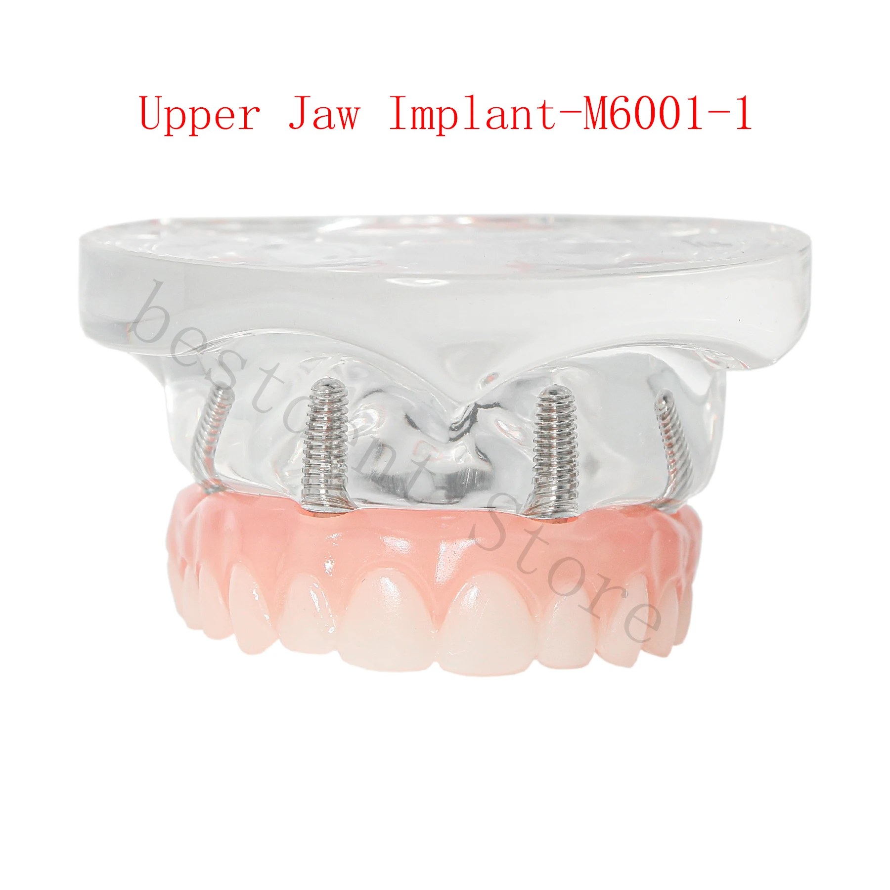 Teeth Model Implant Dental Teach Study Model Demo Overdenture Typodont 4Implants Upper Lower